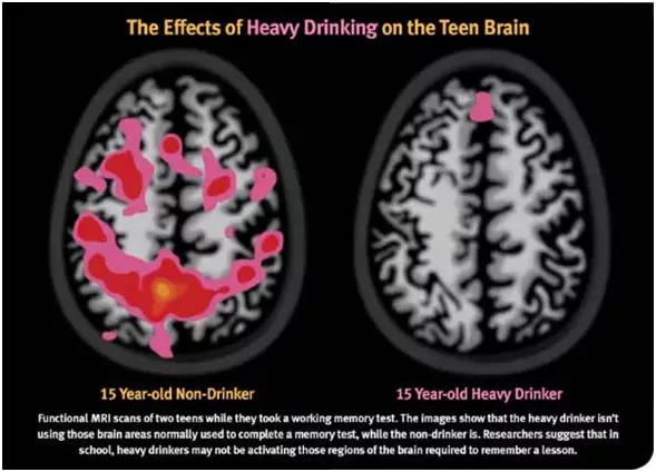 Functional MRI scans of two teens while they took a working memory test. The images show that the heavy drinker isn't using those brain areas normally used to complete a memory test, while the non-drinker is. Researchers suggest that in school, heavy drinkers may not be activating those regions of the brain required to remember a lesson.